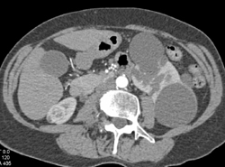 Renal Cell Carcinoma in Right Kidney - CTisus CT Scan