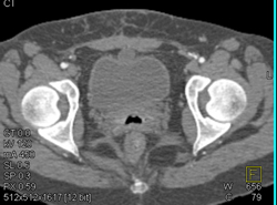 Urachal Diverticulum - CTisus CT Scan