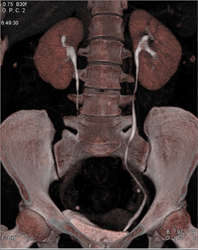 Normal CT Urogram - CTisus CT Scan