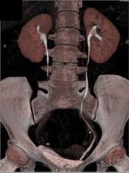 Normal CT Urogram - CTisus CT Scan