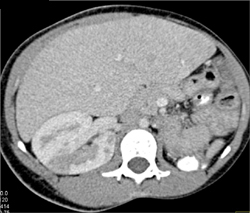 Acute Pyelonephritis in Sickle Cell Patient - CTisus CT Scan