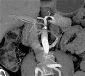 Circum-aortic Renal Vein - CTisus CT Scan