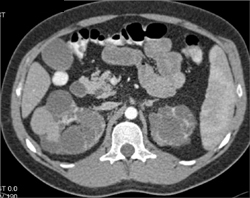 Hemorrhagic Cysts in Pck - CTisus CT Scan