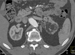 Renal Angiomyolipoma (AML) - CTisus CT Scan