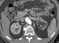 Renal Angiomyolipoma (AML) - CTisus CT Scan