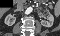 Renal Angiomyolipoma (AML) - CTisus CT Scan