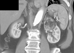 Renal Angiomyolipoma (AML) - CTisus CT Scan