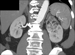 Renal Angiomyolipoma (AML) - CTisus CT Scan