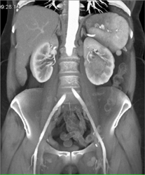 Transitional Cell Carcinoma - CTisus CT Scan