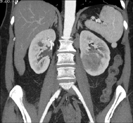 Transitional Cell Carcinoma - CTisus CT Scan