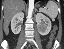 Transitional Cell Carcinoma - CTisus CT Scan