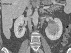 Transitional Cell Carcinoma - CTisus CT Scan