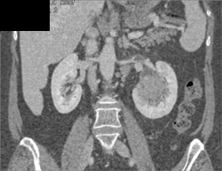 Transitional Cell Carcinoma - CTisus CT Scan