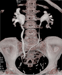 Ct Urogram S/P Bladder Resection-transitional Cell Carcinoma in Left Kidney - CTisus CT Scan