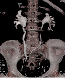 Mildly Dilated Calyces in Patient With A Neobladder - CTisus CT Scan