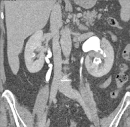 Transitional Cell Carcinoma in Lower Pole of Calyx of Left Kidney - CTisus CT Scan