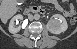 Transitional Cell Caricnoma in Multiple Phases - CTisus CT Scan