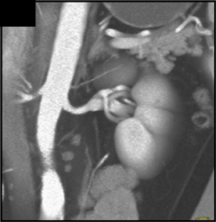 Small Accessory Renal Artery to Upper Pole of the Left Kidney - CTisus CT Scan