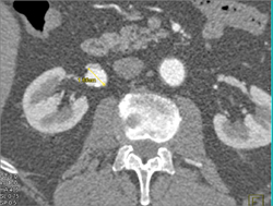 Right Renal Artery Aneurysm - CTisus CT Scan