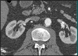 Right Renal Artery Aneurysm - CTisus CT Scan