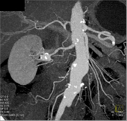 Right Renal Artery Aneurysm - CTisus CT Scan