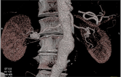 Right Renal Artery Aneurysm - CTisus CT Scan