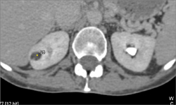 Renal Angiomyolipoma (AML) - CTisus CT Scan