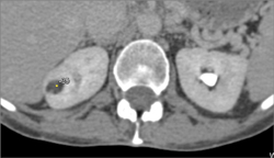 Renal Angiomyolipoma (AML) - CTisus CT Scan