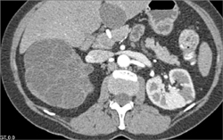 Cystic Renal Cell Carcinoma - CTisus CT Scan