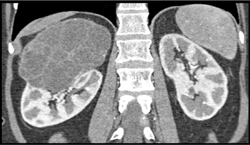 Cystic Renal Cell Carcinoma - CTisus CT Scan