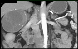 Cystic Renal Cell Carcinoma - CTisus CT Scan