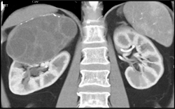 Cystic Renal Cell Carcinoma - CTisus CT Scan