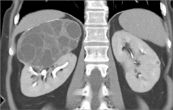 Cystic Renal Cell Carcinoma - CTisus CT Scan