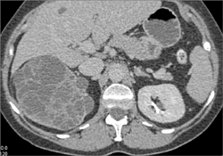 Cystic Renal Cell Carcinoma - CTisus CT Scan