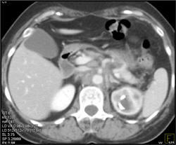 Retroperitoneal Fibrosis - CTisus CT Scan