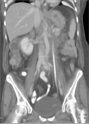 Retroperitoneal Fibrosis - CTisus CT Scan