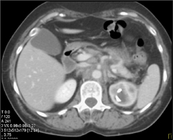 Retroperitoneal Fibrosis - CTisus CT Scan