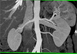 2 Left Renal Arteries With Pre-hilar Branching Fo the Dominant Renal Arteries - CTisus CT Scan