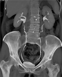 Normal CT Urogram - CTisus CT Scan