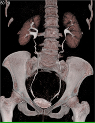 Normal CT Urogram - CTisus CT Scan