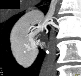 Arteriovenous Malformation (AVM) of the Right Kidney Invades the Lower Pole Calyx-seen With Multiple Phases - CTisus CT Scan