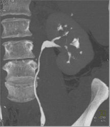 Transitional Cell Carcinoma - CTisus CT Scan