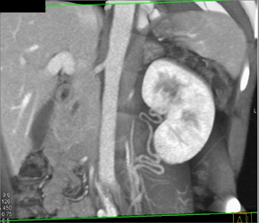 Dilated Ovarian Artery - CTisus CT Scan