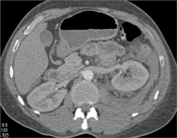 Bleed in Left Para-renal Space - CTisus CT Scan