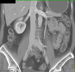 Left Renal and Gonadal Vein - CTisus CT Scan