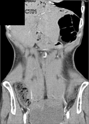 Renal Cell Carcinoma - CTisus CT Scan