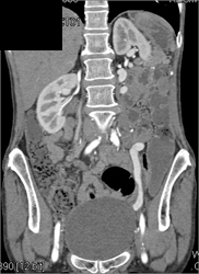Left Renal Cell Carcinoma - CTisus CT Scan
