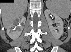 Multiple Right Kidney-cystic Dysplastic Kidney - CTisus CT Scan