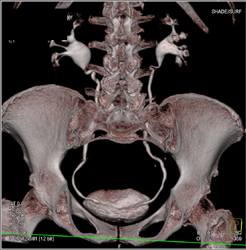 Normal CT Urogram in Multiple Views - CTisus CT Scan