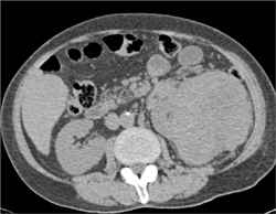 Renal Cell Carcinoma - CTisus CT Scan